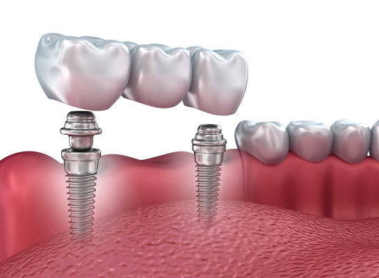 Dental Implants in Philadelphia, PA