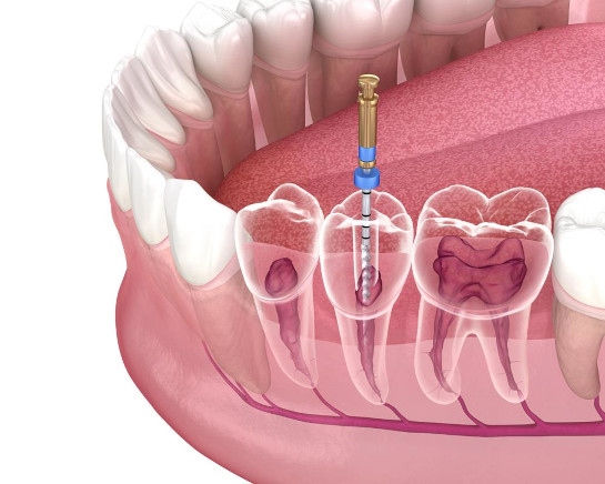 root canal treatment in  Philadelphia, PA 