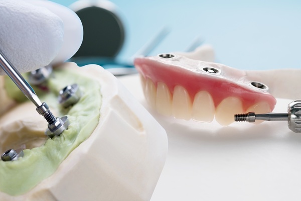 Tooth Replacement    : A Guide To Implant Supported Dentures